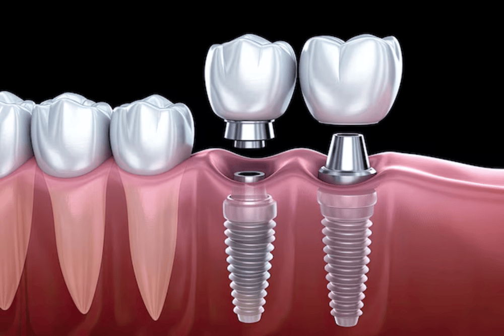 tooth-implant-process-what-to-expect